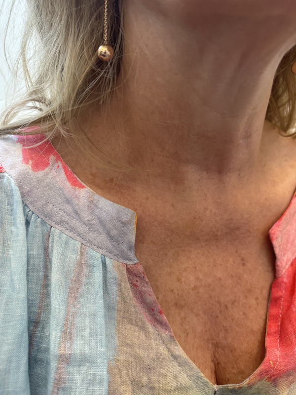 Neck and décolletage after exvivo treatment showing reduced wrinkles
